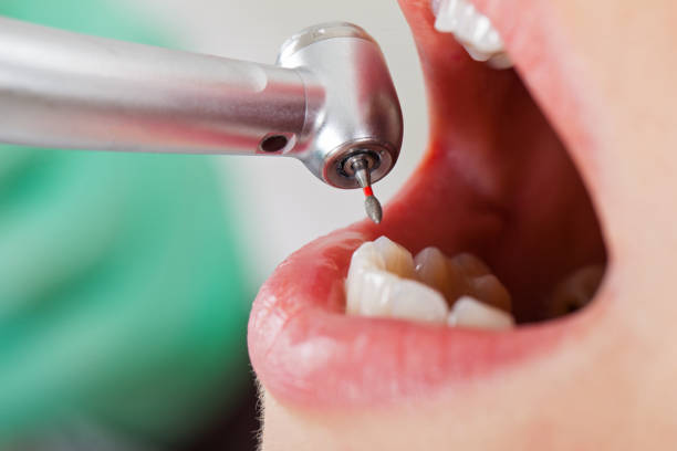 Best Emergency Root Canal Treatment in Midland, TX
